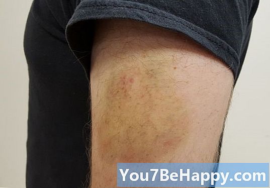 Bruise vs. hematom - Care este diferența?
