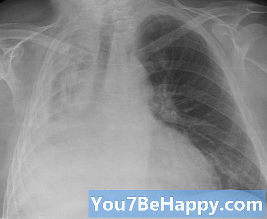 Pneumothorax vs. Atelektaasi - Mikä ero on?