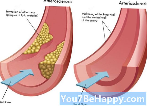 Diferencia entre la aterosclerosis y la arteriosclerosis
