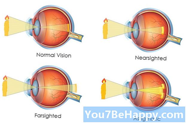 Diferença entre miopia e hipermetropia