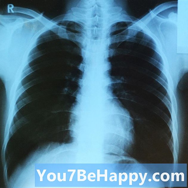 Sự khác biệt giữa phổi phải và phổi trái